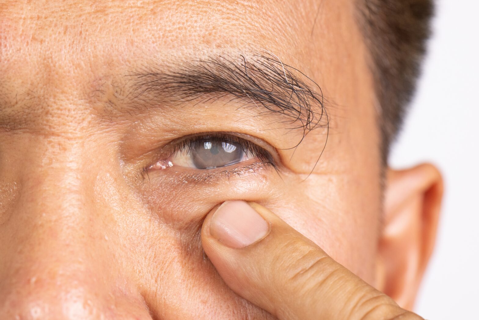 Rhinoplasty