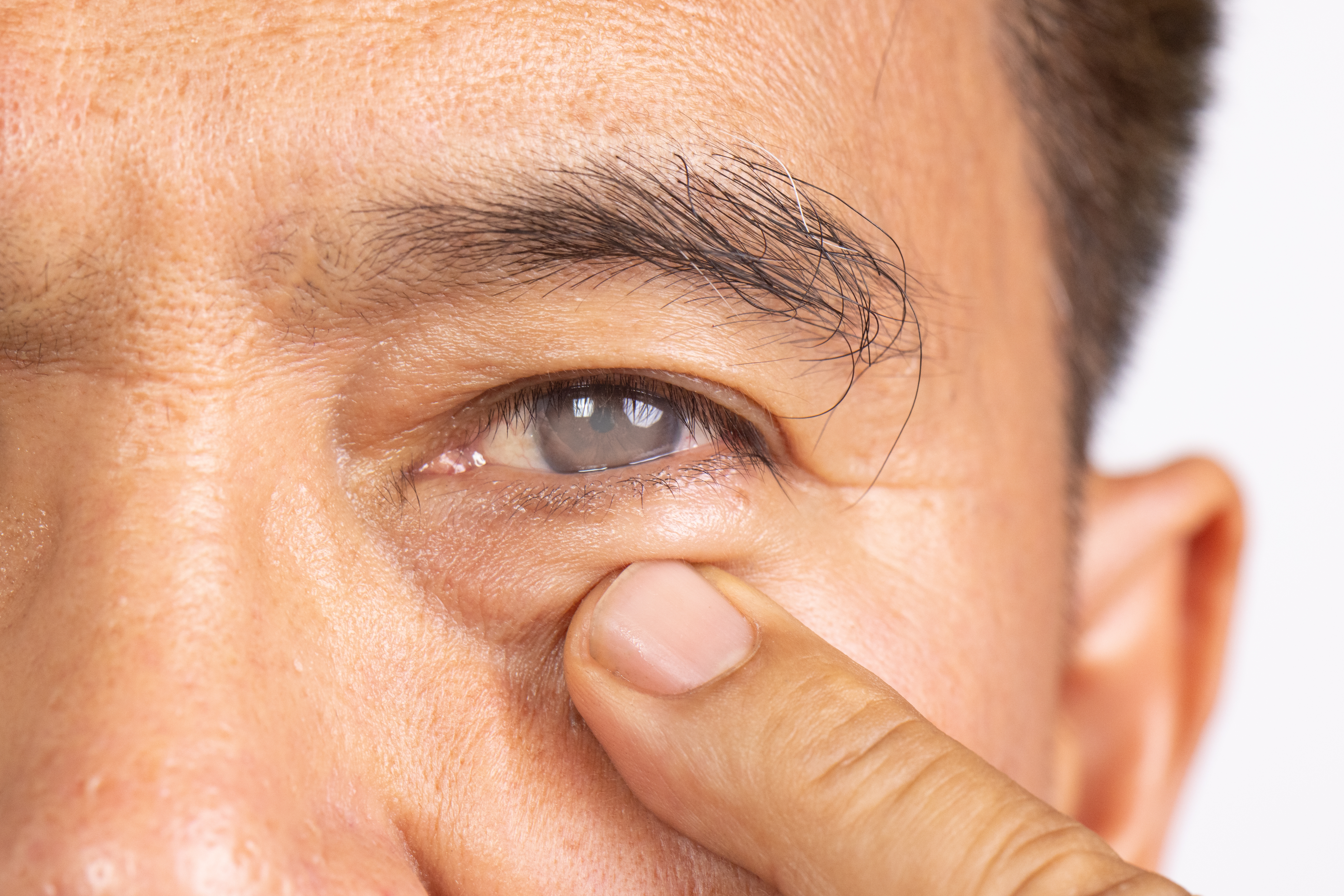 Am I a Candidate for Glaucoma Treatment?